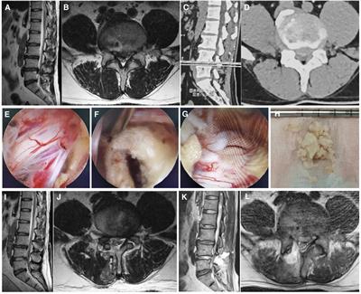 Case Report: Bacterial meningitis due to cerebrospinal fluid leakage following unilateral biportal endoscopic spinal surgery: a cautionary tale